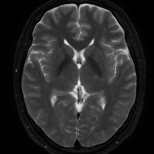 자기공명영상 (Magnetic Resonance Imaging: MRI)