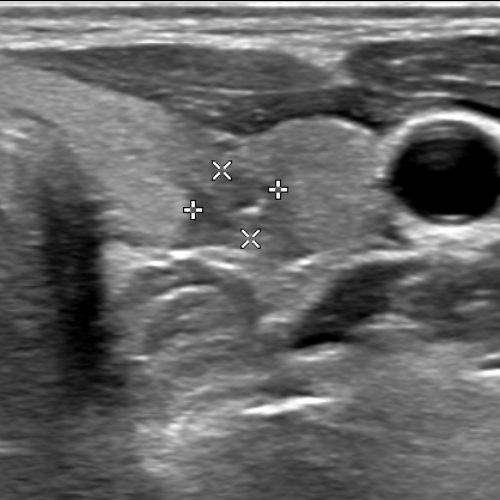 초음파촬영 (Ultrasonography)