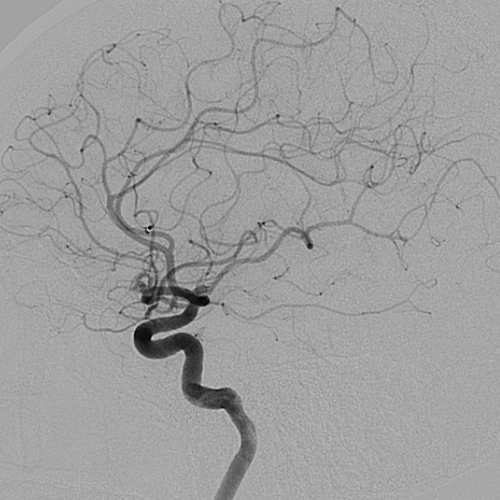 혈관조영술 (Digital Substraction Angiography)