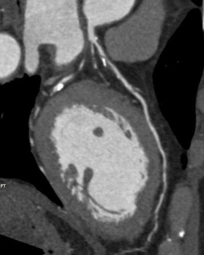 컴퓨터단층촬영 (CT, computed tomography)